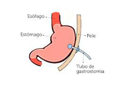 Gastrostomia