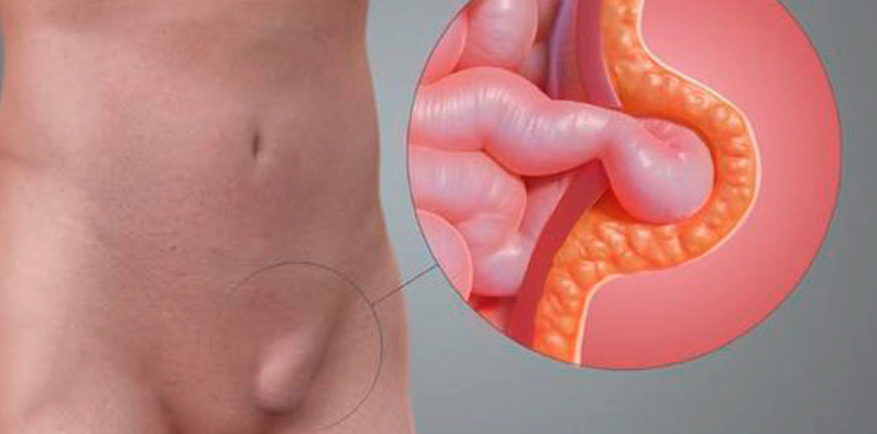 Herniorrafia-Inguinal
