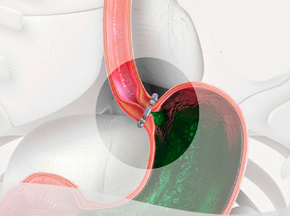 cirurgia-de-refluxo-em-sp