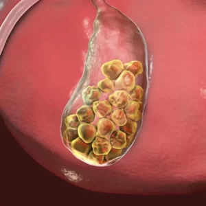 pedras-na-vesicula-cirurgia