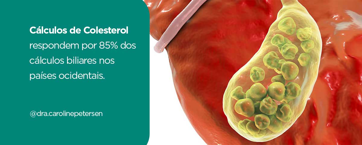 calculos-de-colesterol-vesicula-biliar