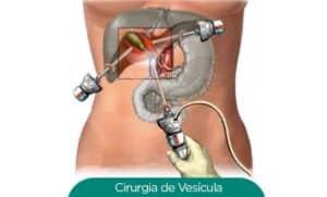 cirurgia-vesicula-sp