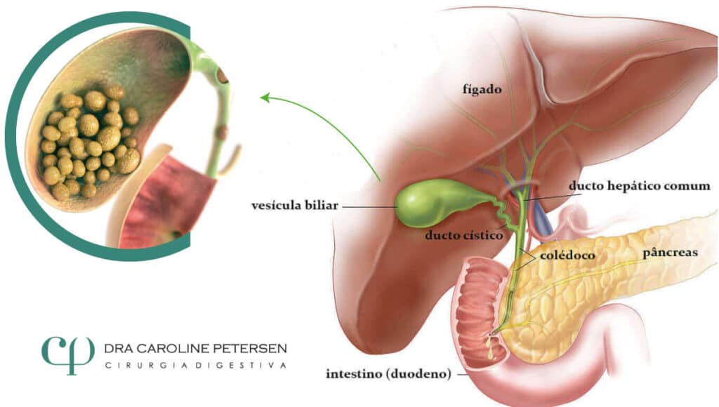 vesicula-biliar-cirurgia-sp